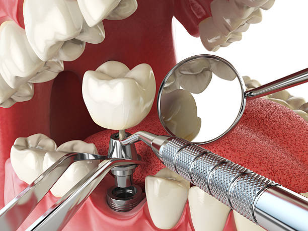 Best Emergency Broken Tooth Repair in Marionville, MO
